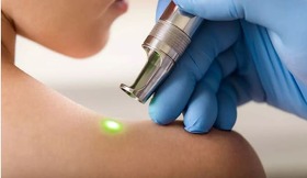 лазернотерапія